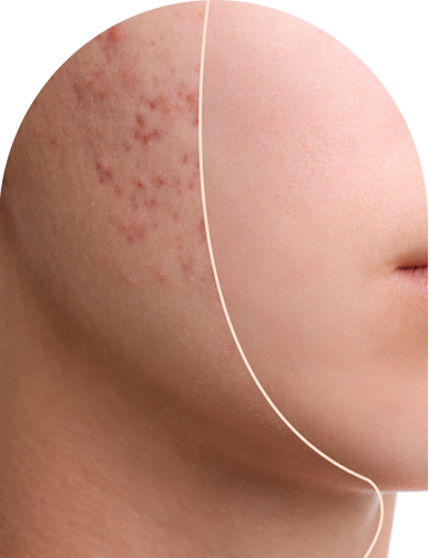 Microneedling Treatment for Acne Scars