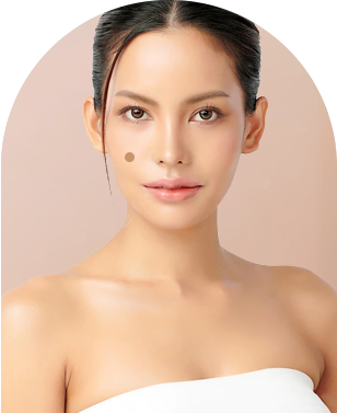 Microneedling Treatment in Ahmedabad