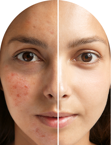 Best Acne Doctor in Ahmedabad