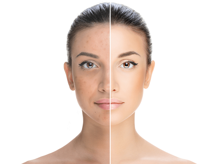 Image Lightening Lift Peel