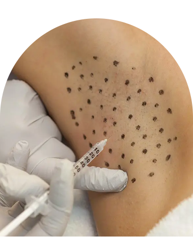 Sweating Treatment