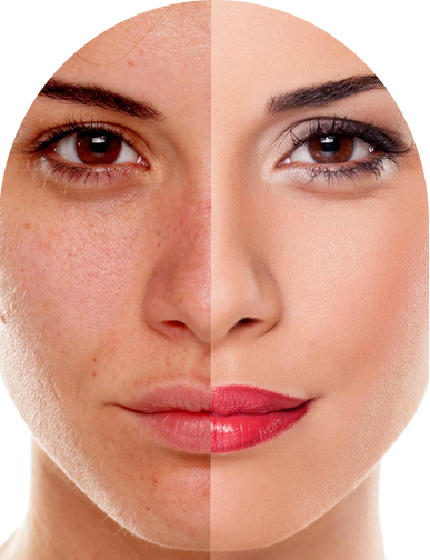Sun Damage Treatment