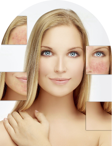 Rosacea Treatment