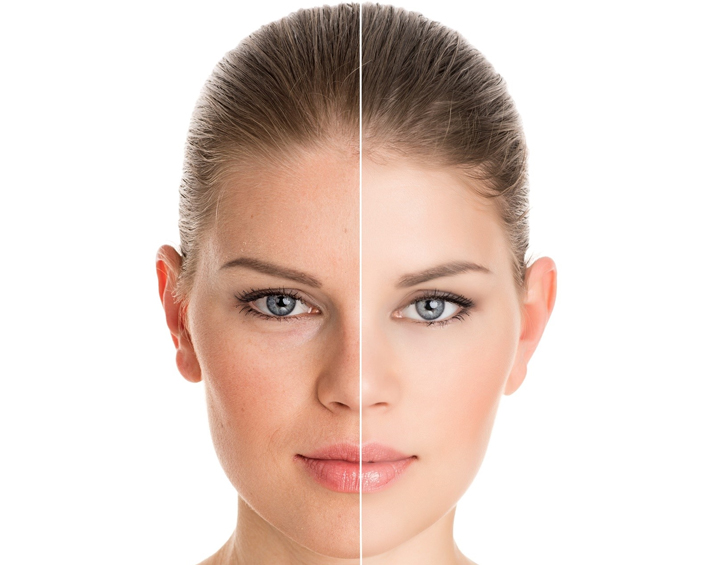Anti Redness Therapy in Ahmedabad