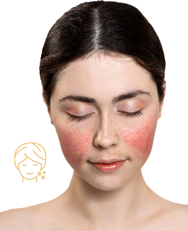 Rosacea