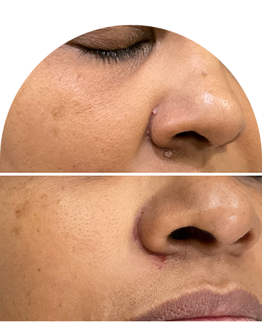 MOLE / WART Removal in Ahmedabad